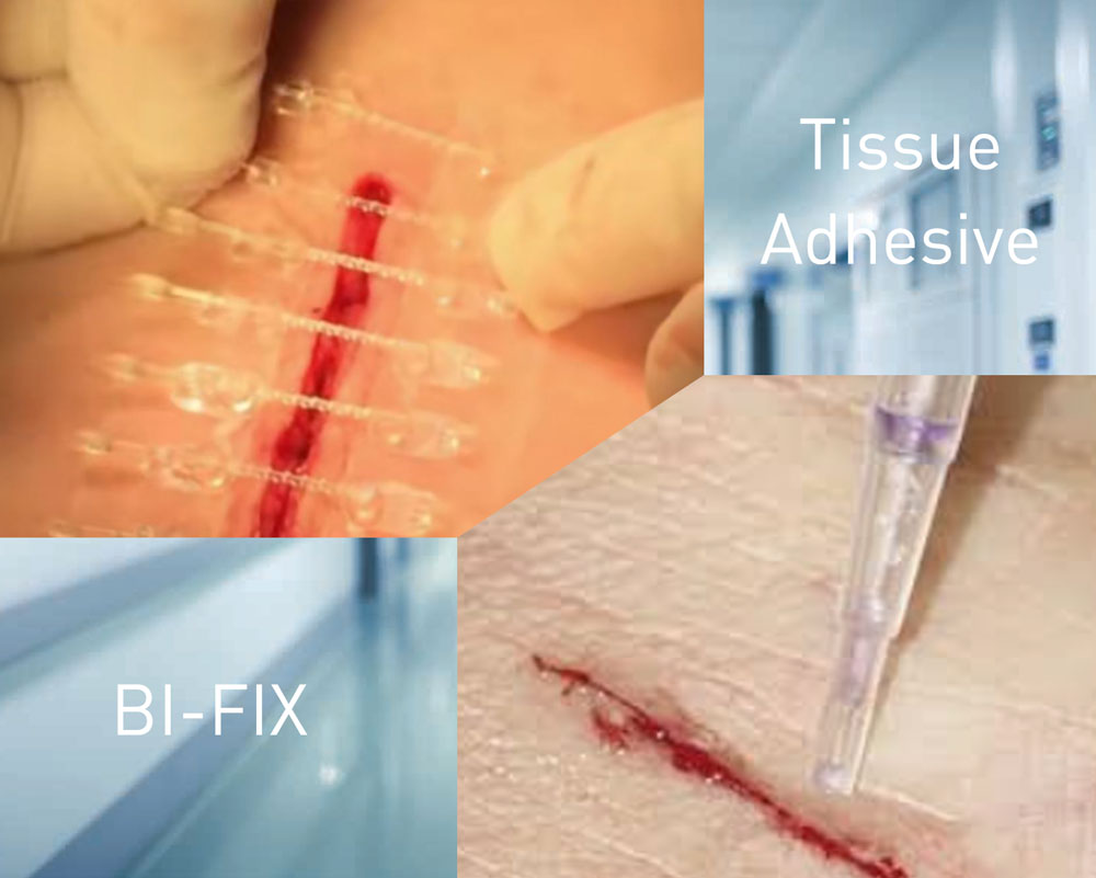 How Is Tissue Adhesive Used For Wound Closure And Which Is A Good