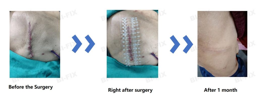 BI-FIX applied in Orthopedics