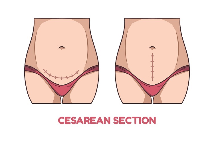 C section types